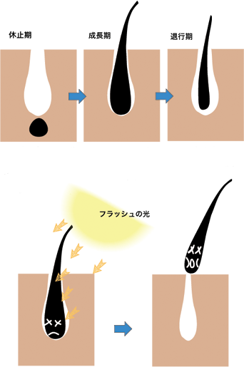 脱毛のしくみ